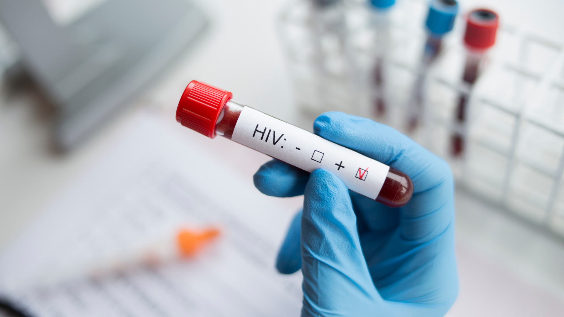 Exame de HIV positivo em tubo de coleta de sangue, ilustrando artigo sobre os direitos previdenciários e assistenciais das pessoas vivendo com HIV perante o INSS.